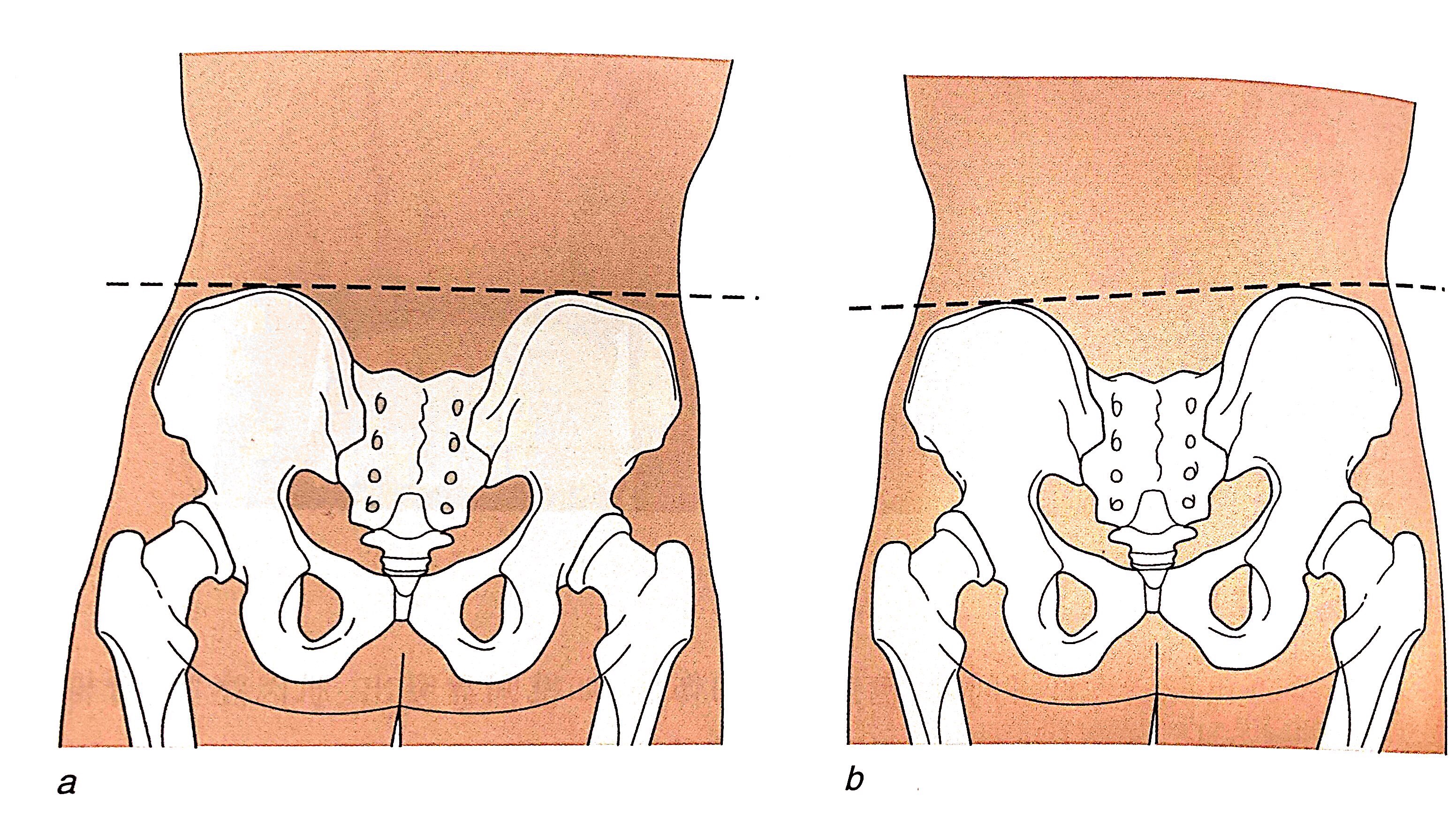 图a显示正常的骨盆,图b显示的骨盆右侧向上倾斜,左侧向下倾斜
