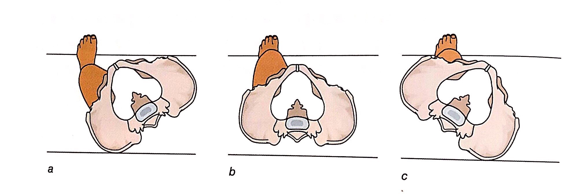 a.骨盆逆时针旋转(向左)  b.正常骨盆位置  c.