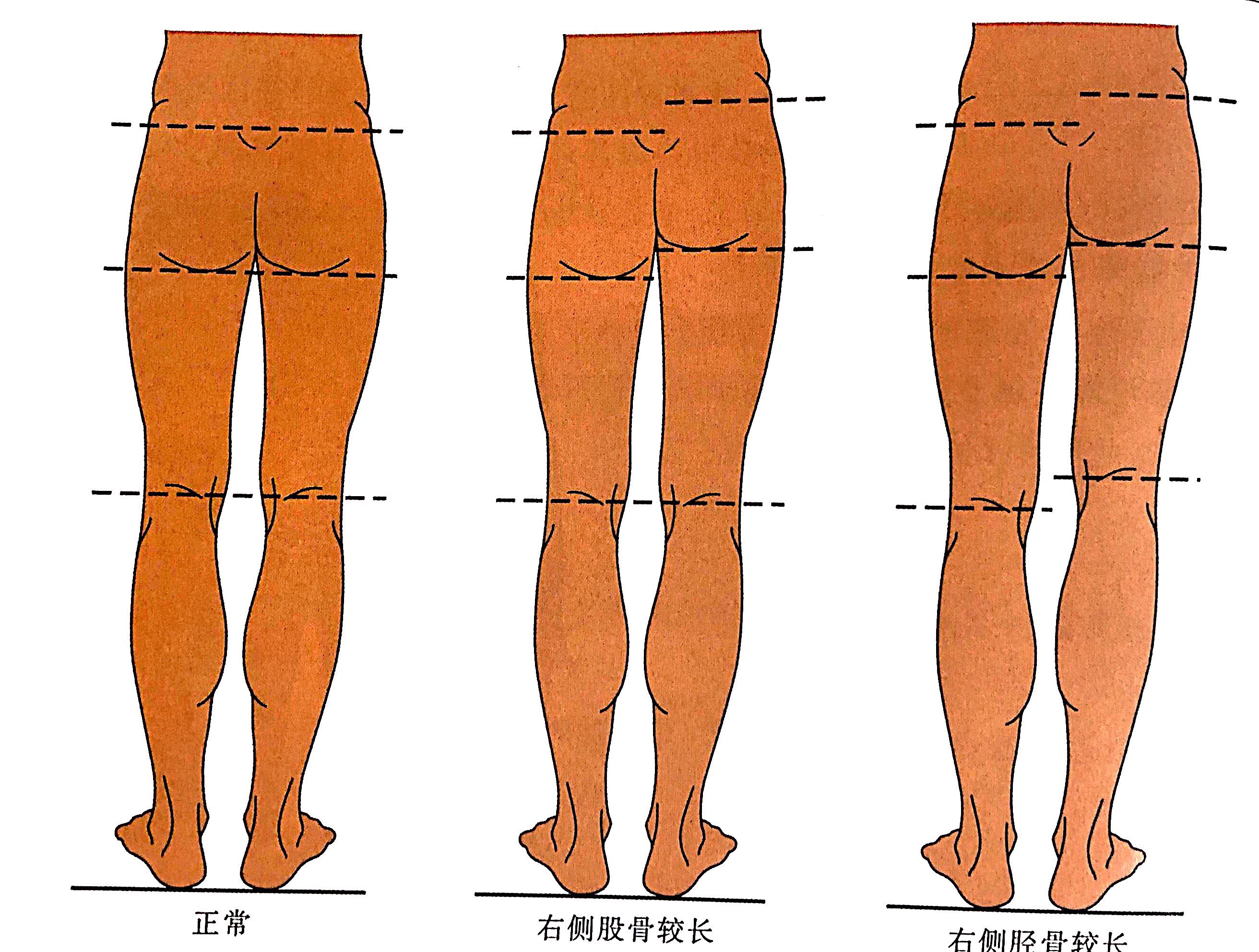 中讲到的,若受试者右侧的骨盆向上倾斜,那么他左侧的臀位线将相对更深